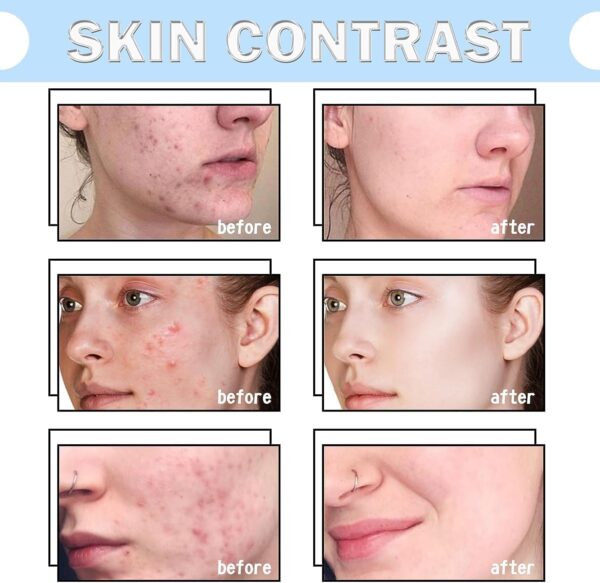 Skin Treats Collagen & Hyaluronic Acid Five Day Skincare System - 7 Pieces - Image 4